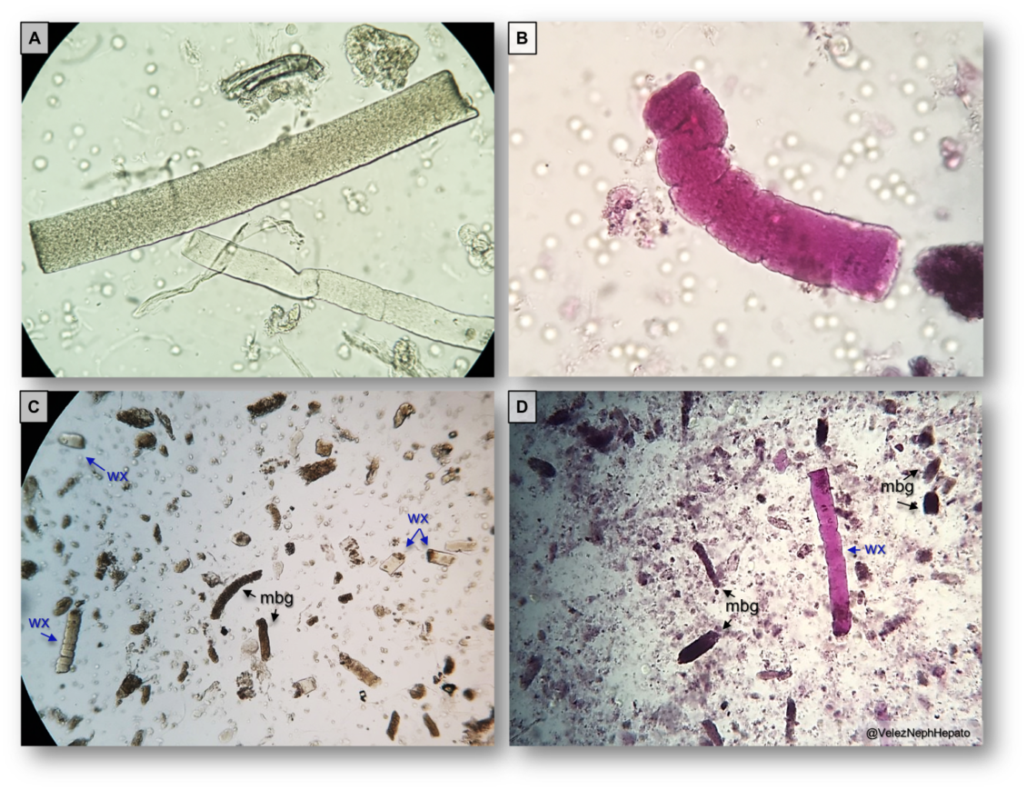 Urine Sediment Of The Month Mixed Cellular Casts Renal Fellow Network Vrogue 3393