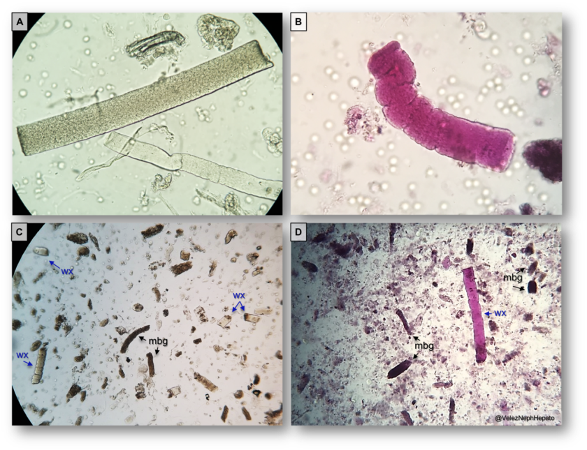 Urine Sediment Of The Month Waxy Casts Renal Fellow Network 5597