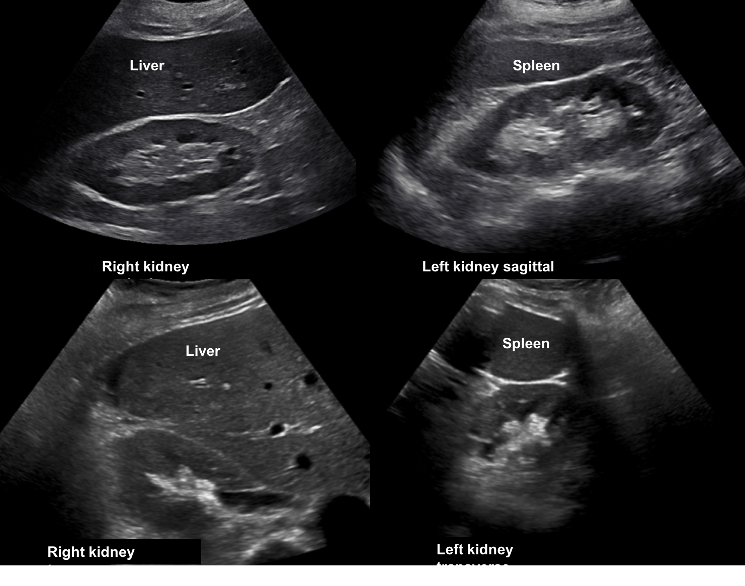 kidney ultrasound images normal