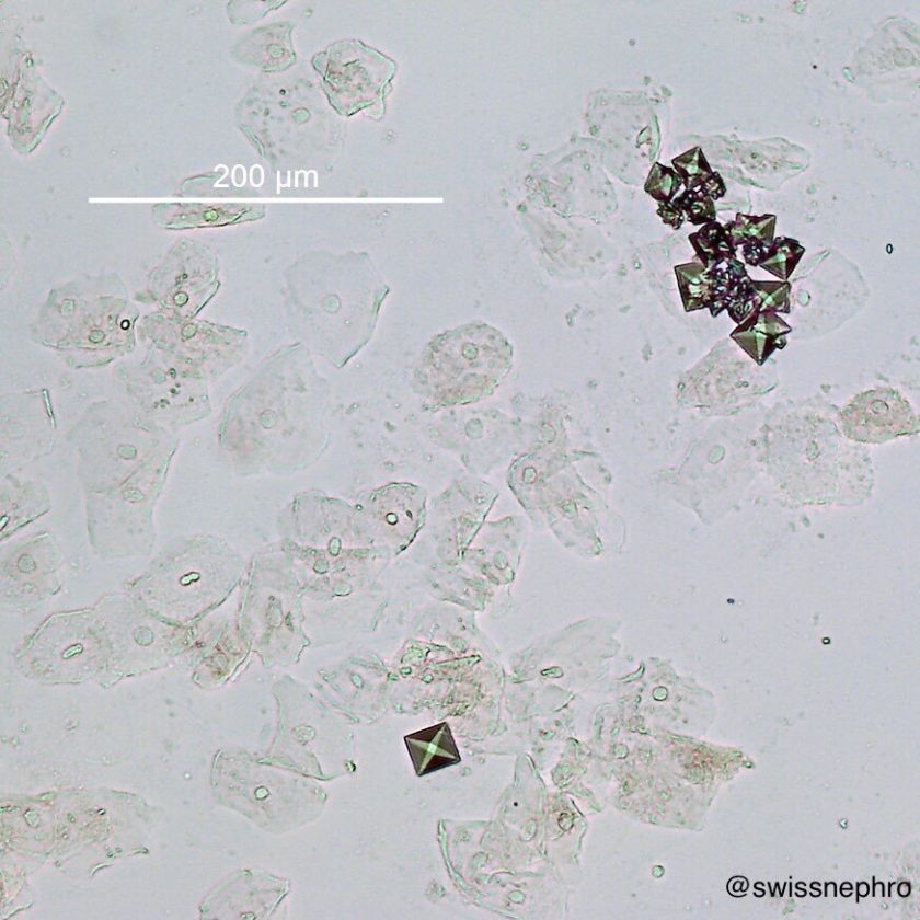 Urine Sediment Of The Month Common Crystals Renal Fellow Network 3161