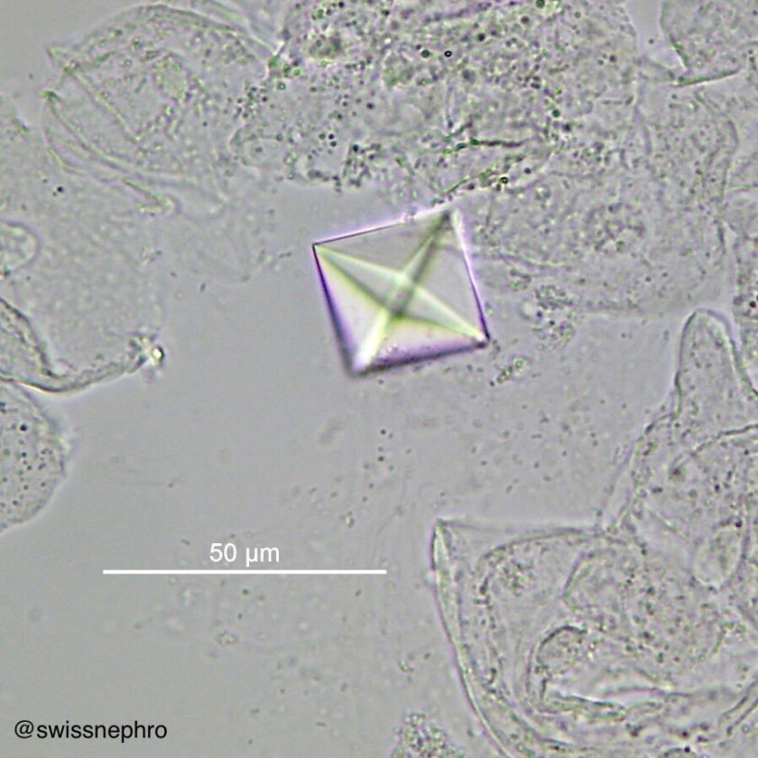 Urine Sediment Of The Month Common Crystals Renal Fellow Network 9782