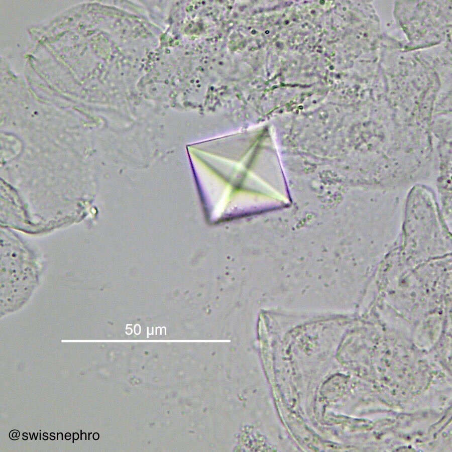 calcium phosphate crystals in urine sediment