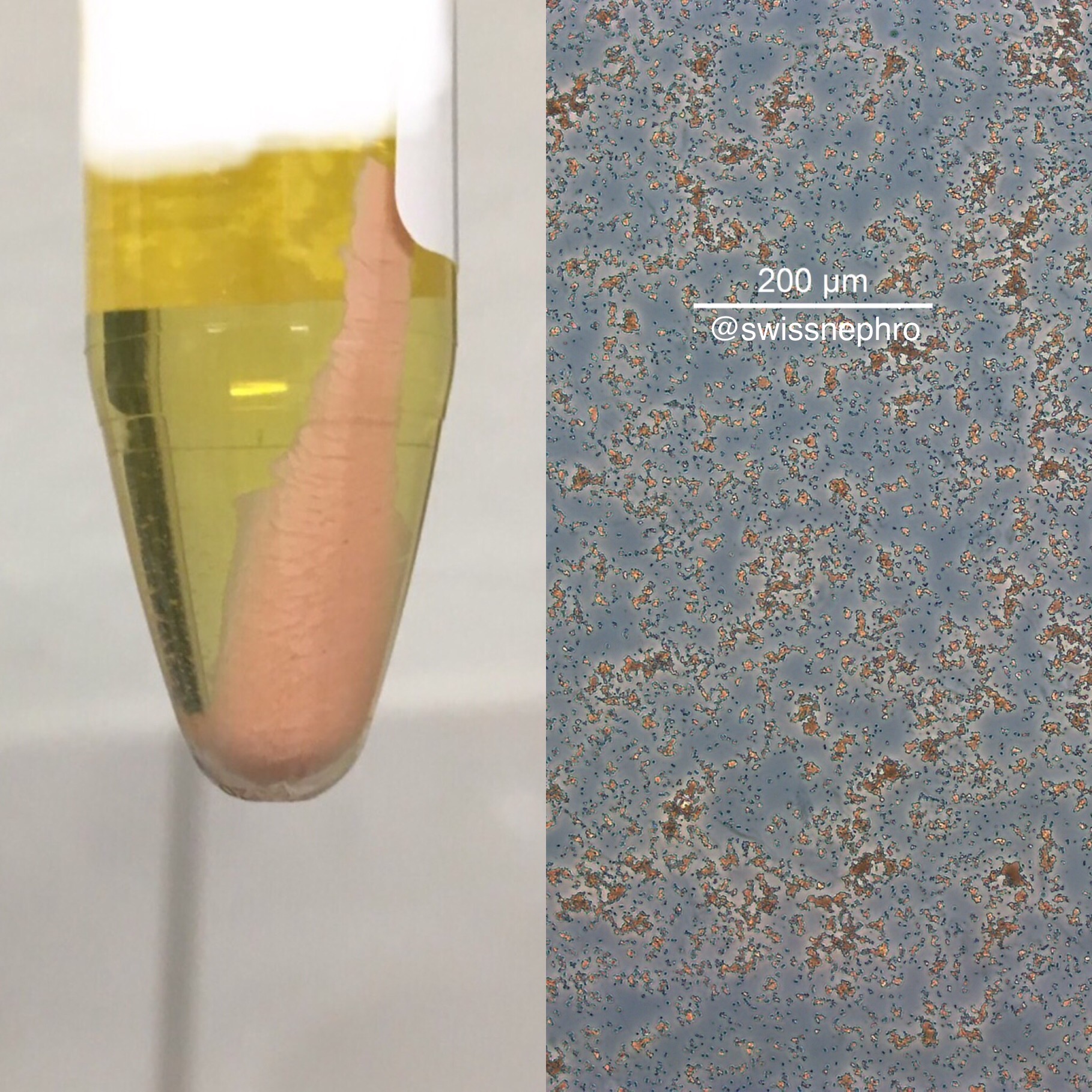 Urine Sediment Of The Month The Visible Sediment Renal Fellow Network 6309