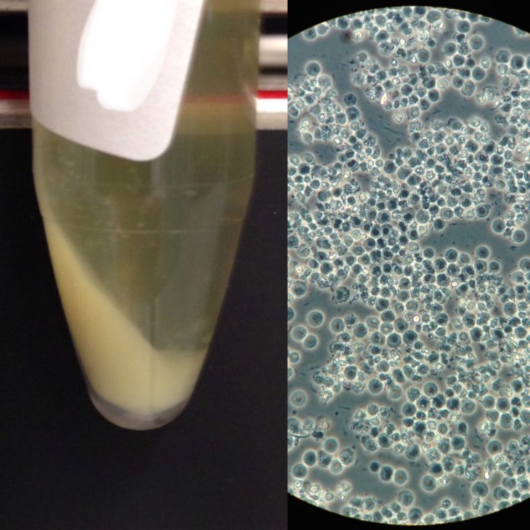 Urine Sediment Of The Month The Visible Sediment Renal Fellow Network 5220