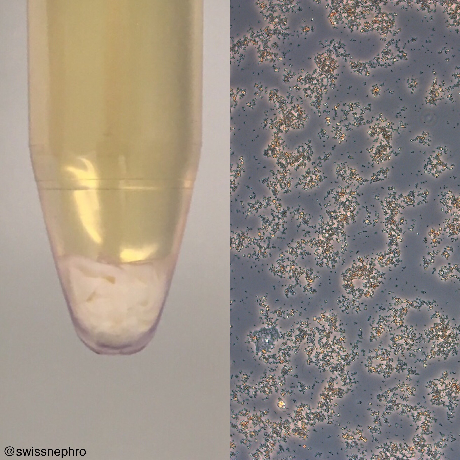 Urine Sediment Of The Month The Visible Sediment Renal Fellow Network 8159
