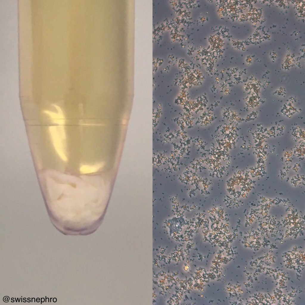 Urine Sediment Of The Month Microorganisms Renal Fell 5837