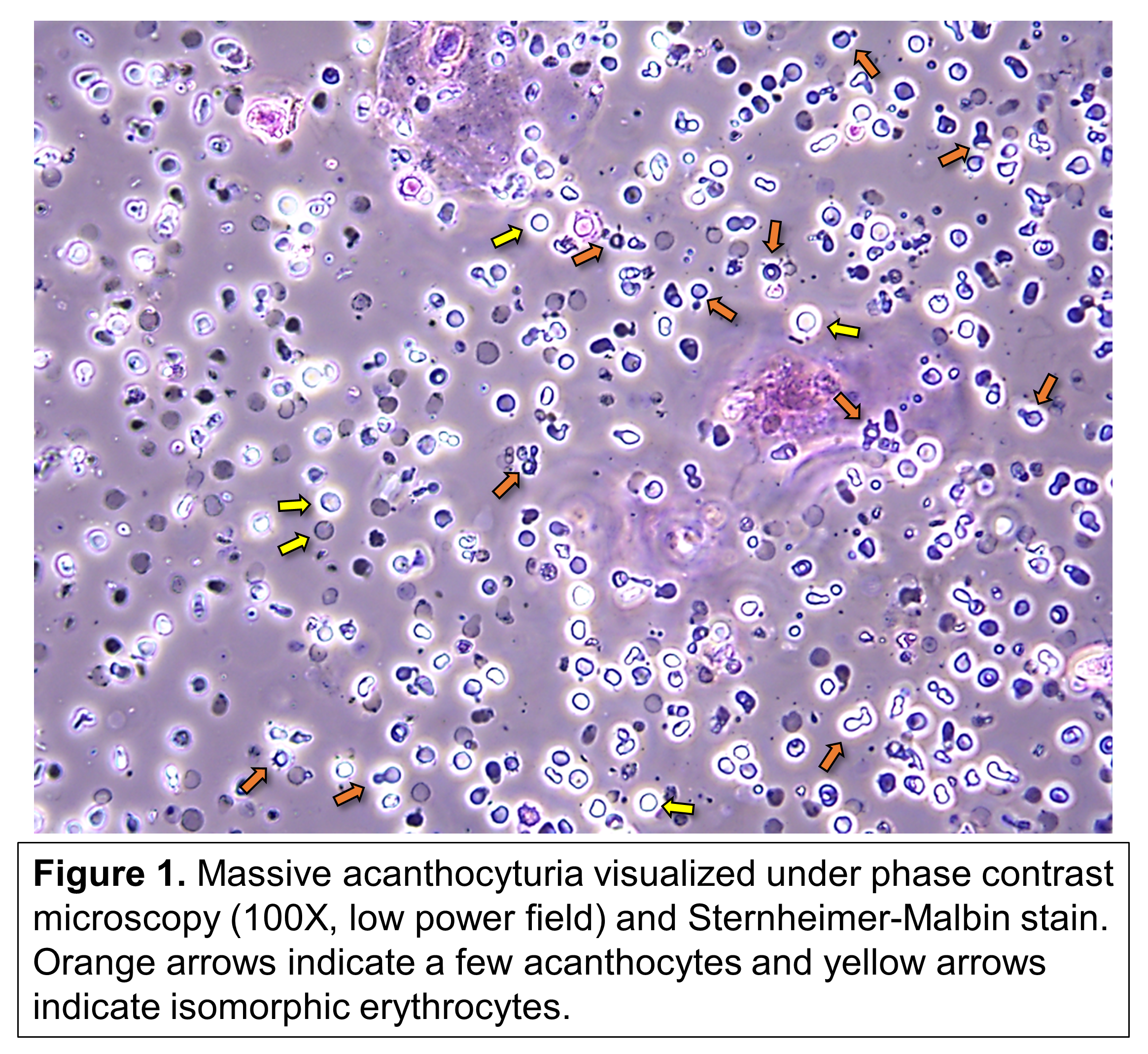 Активные лейкоциты. Клетки Штернгеймера Мальбина. Лейкоциты в моче фото под микроскопом. Микроскопия осадка мочи эритроциты. Dysmorphic Red Blood Cells.