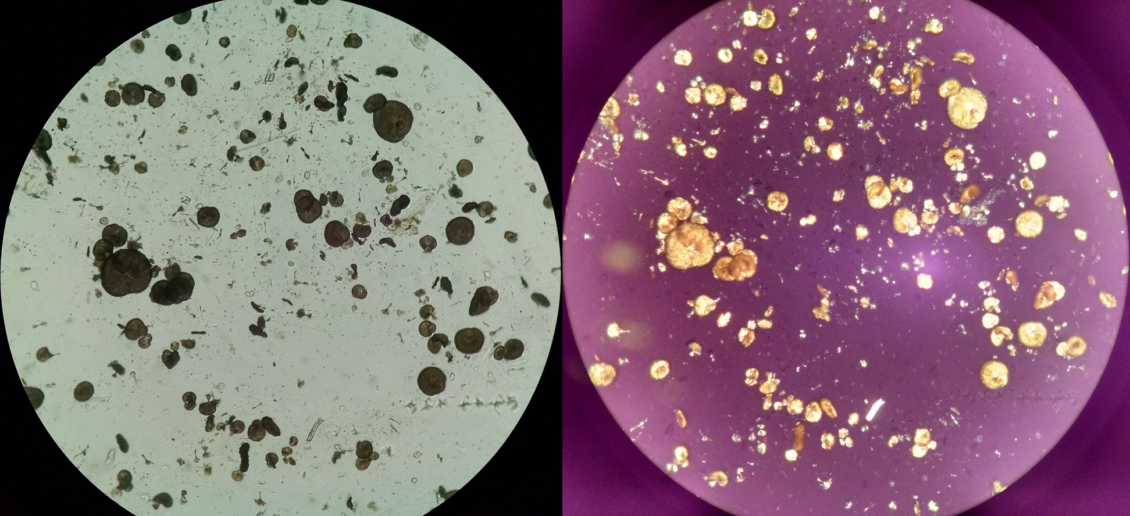 Urine Sediment Of The Month Drugs Crystalluria Renal Fellow Network