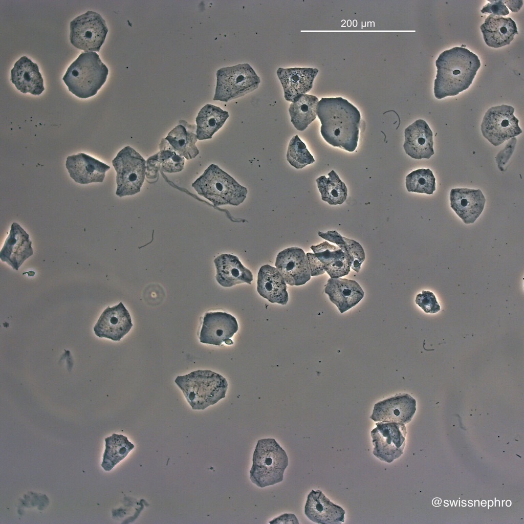 Renal Cells In Urine Sediment 9097
