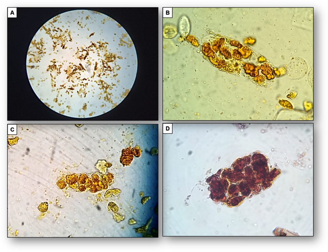 Urine Sediment of the Month: Findings in Cirrhosis, Cholestasis, and ...