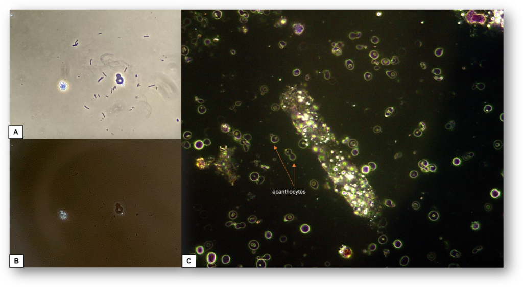 Urine Sediment Of The Month Urinal Sediment Microscopy 9171