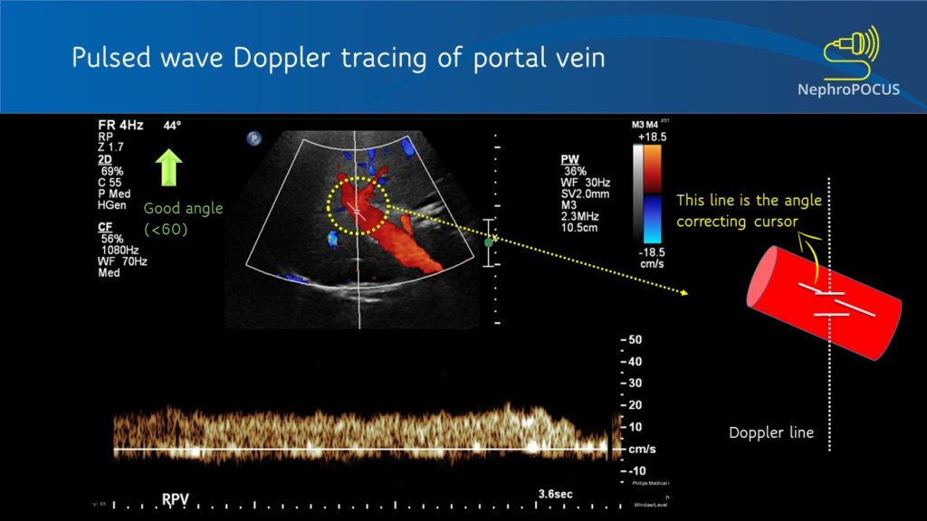Basics of Doppler Ultrasound for the Nephrologist- Part 2 - Renal