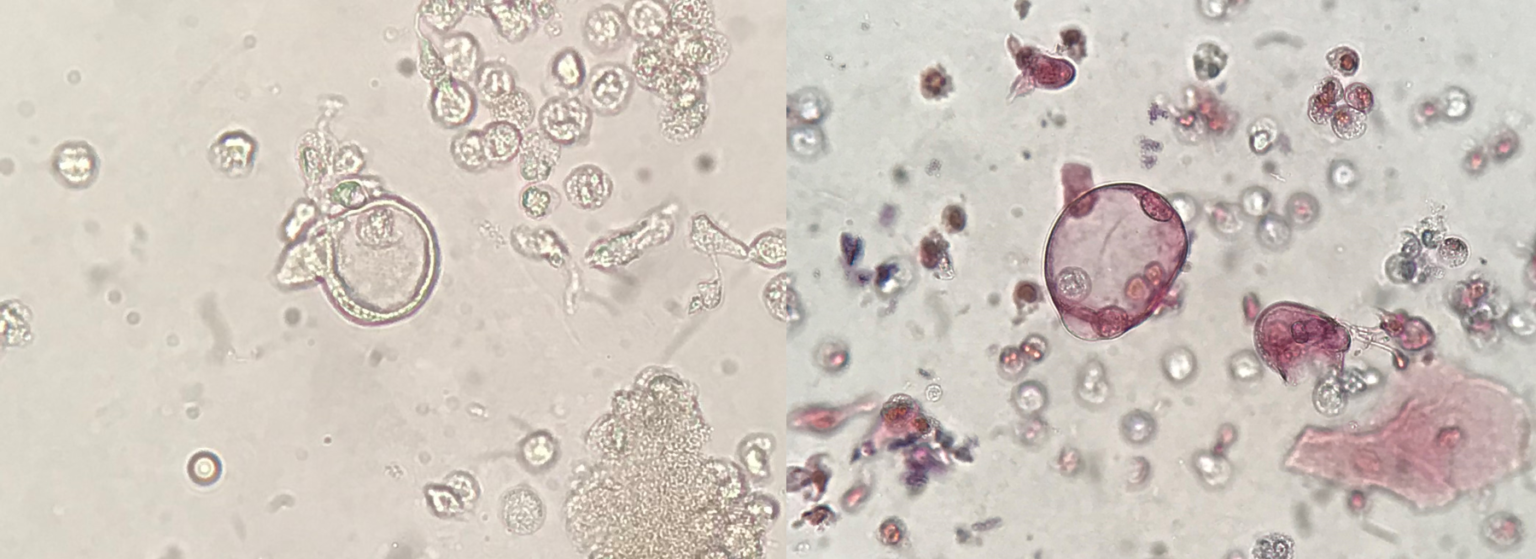 Urine Sediment Of The Month When You Hear Hoofbeats Unusual Cell Types In Urine Renal 9117