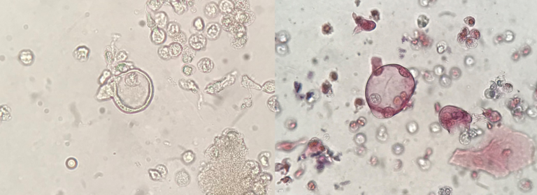 Urine Sediment Of The Month When You Hear Hoofbeats Unusual Cell Types In Urine Renal 7658