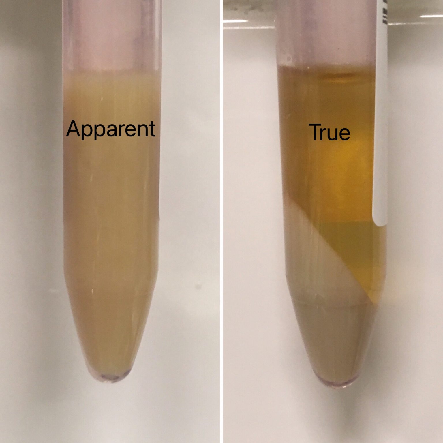 Urine Sediment Of The Month Urines True Colors Renal Fellow Network 2853