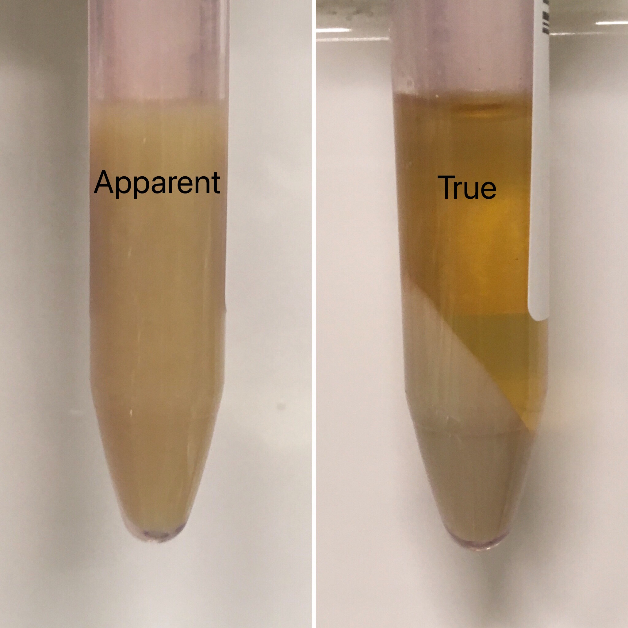 Urine Sediment Of The Month Urines True Colors Renal Fellow Network