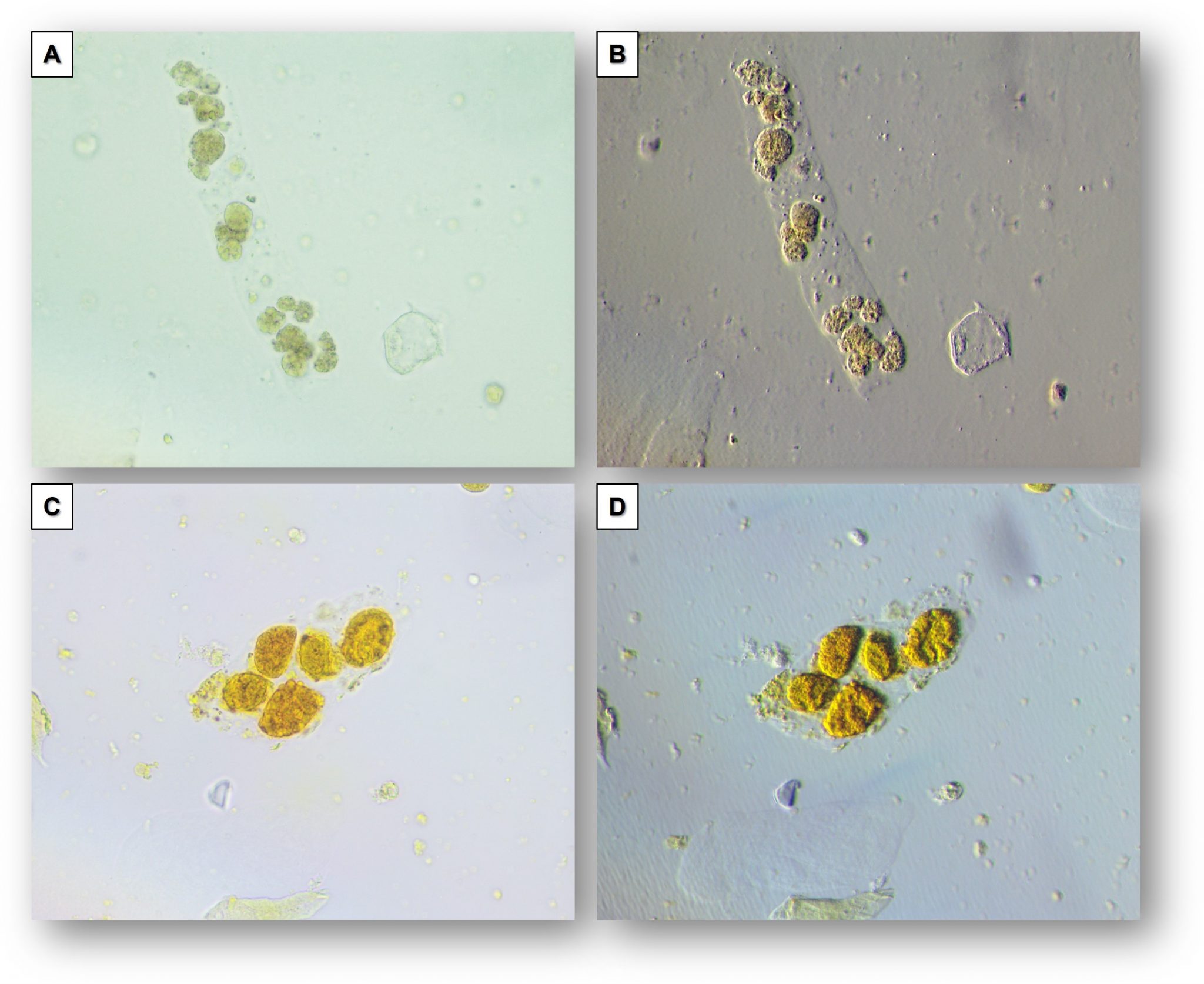 Urine Sediment of the Month: Oblique Illumination in Microscopy - Renal ...