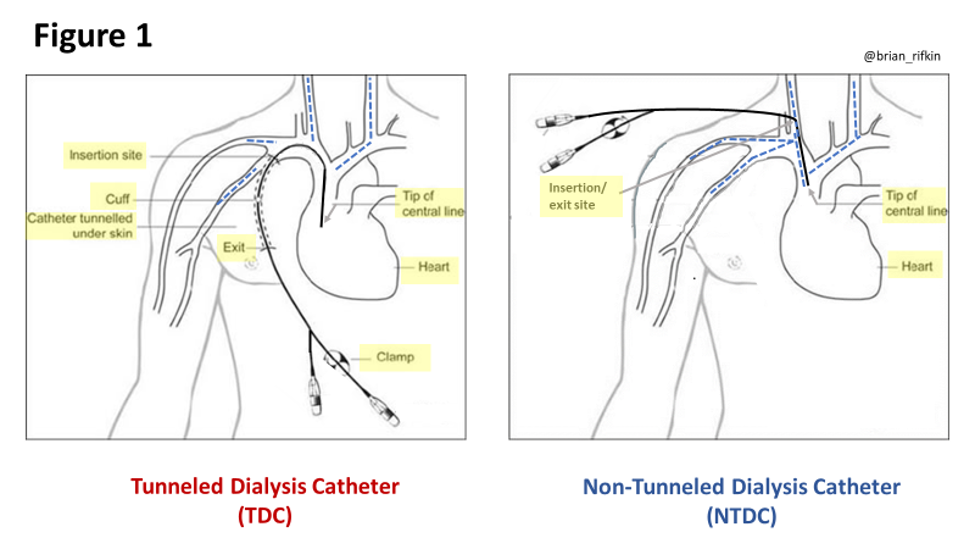 hemodialysis tunneled catheter